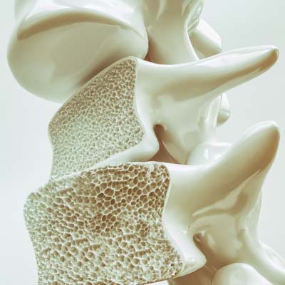 Can People With Osteoporosis Go To The Chiropractor?